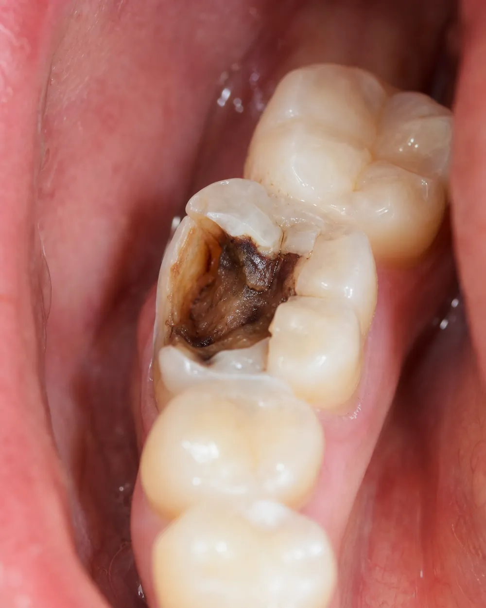 A badly decayed and broken tooth that needs a tooth extraction