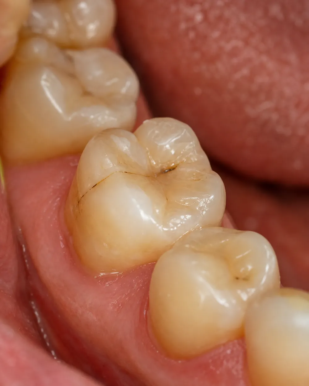 Close-up of a cracked molar that needs a dental crown