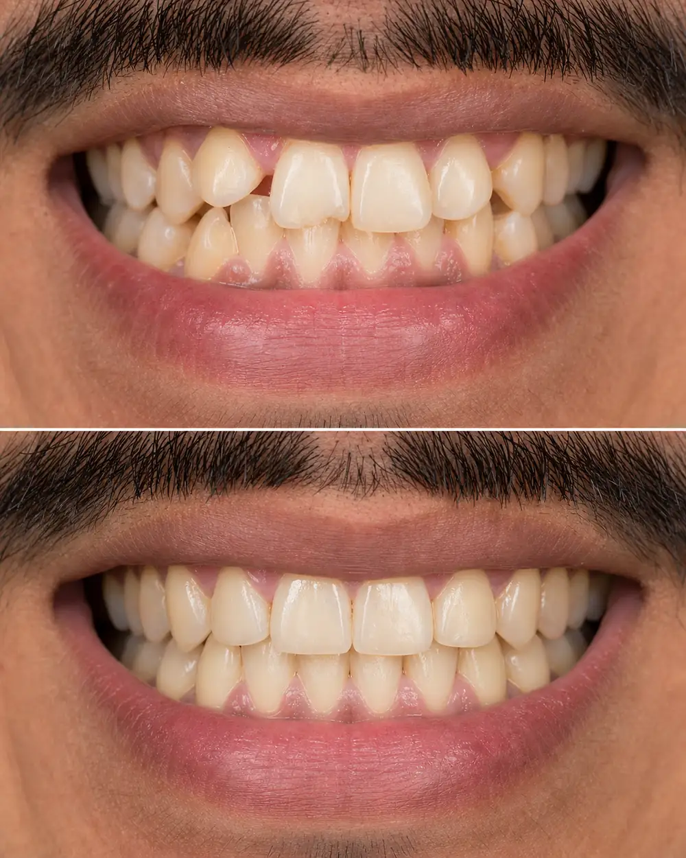 Illustration of crowded teeth straightened with Invisalign clear aligners