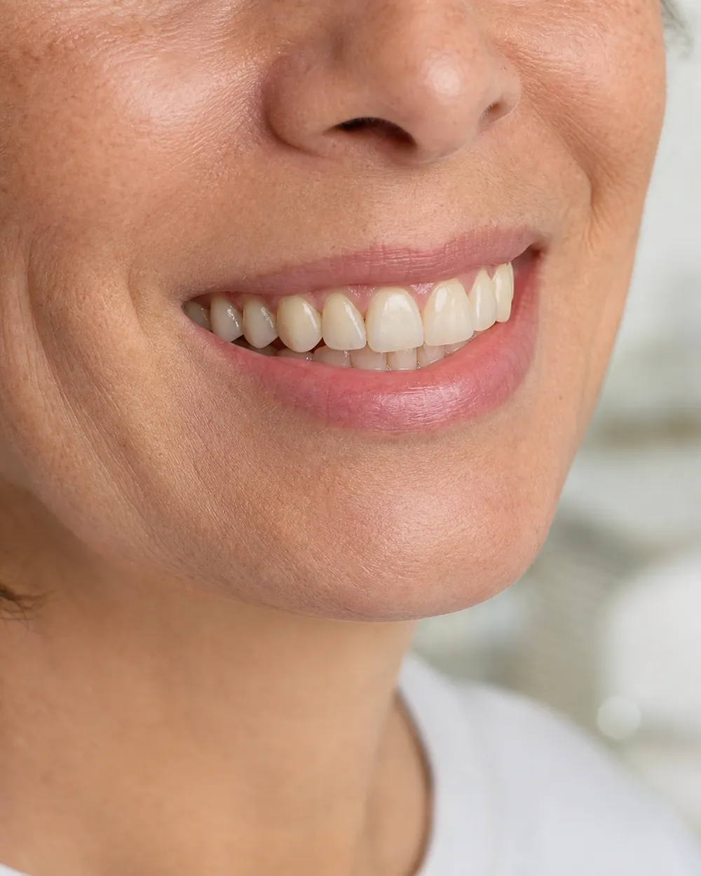 A close-up of a healthy, natural-looking white smile after whitening