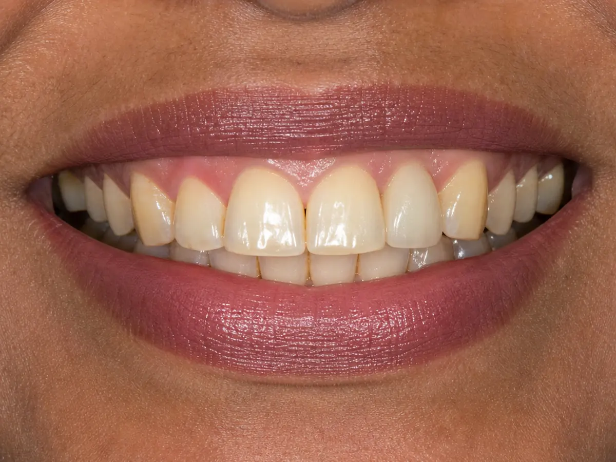 Single implant and crown after: the gap filled with a natural-looking tooth