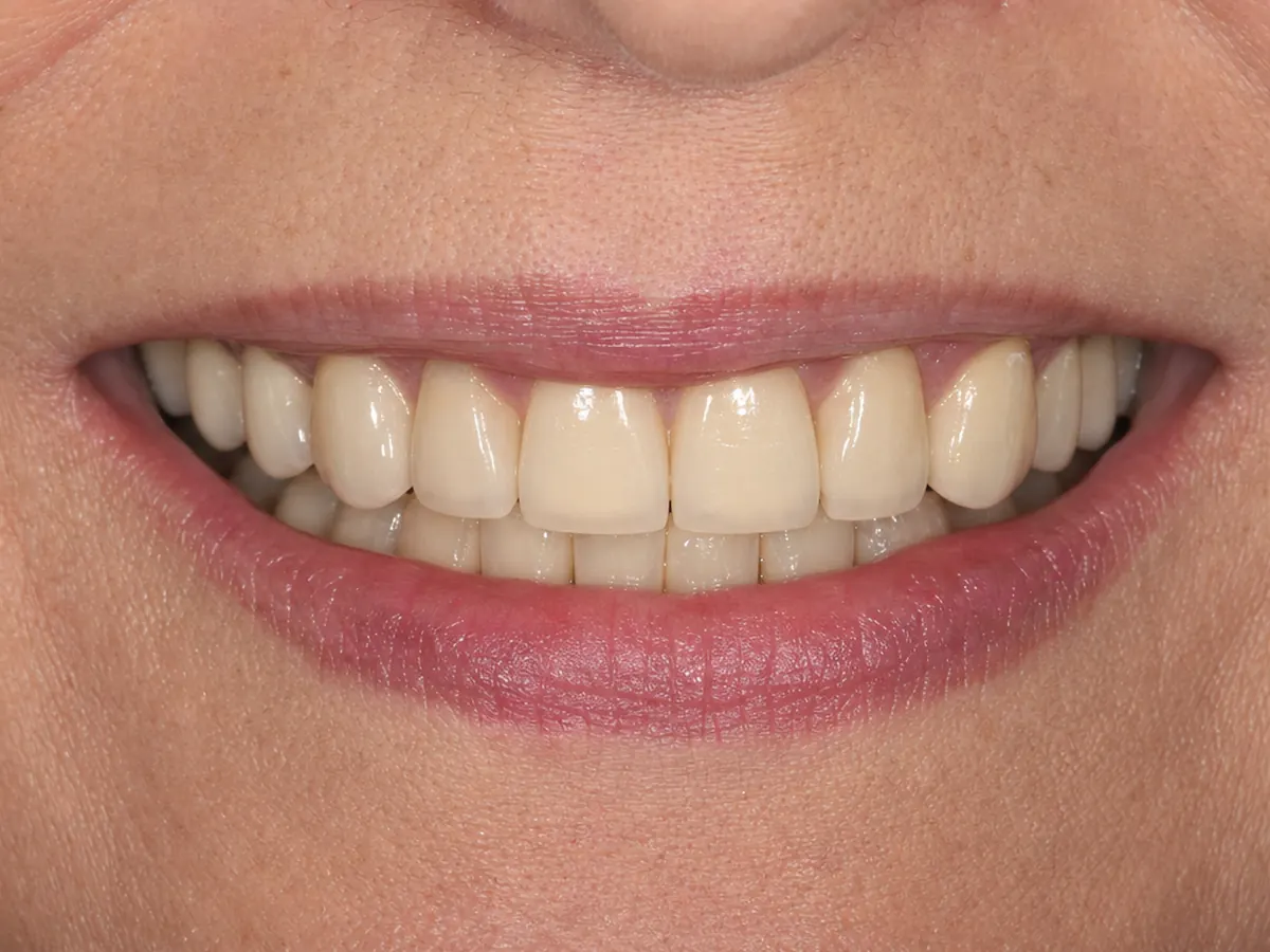 Crowns and bridge after: restored, natural-looking teeth