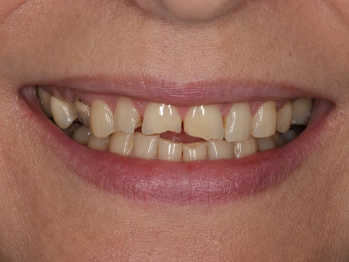 Crowns and bridge before: broken and worn-down teeth