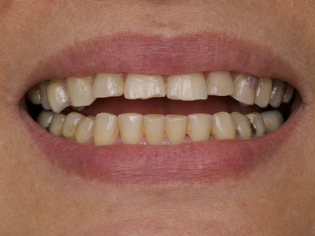 Full-mouth rehabilitation before: extensive wear and damage across the teeth