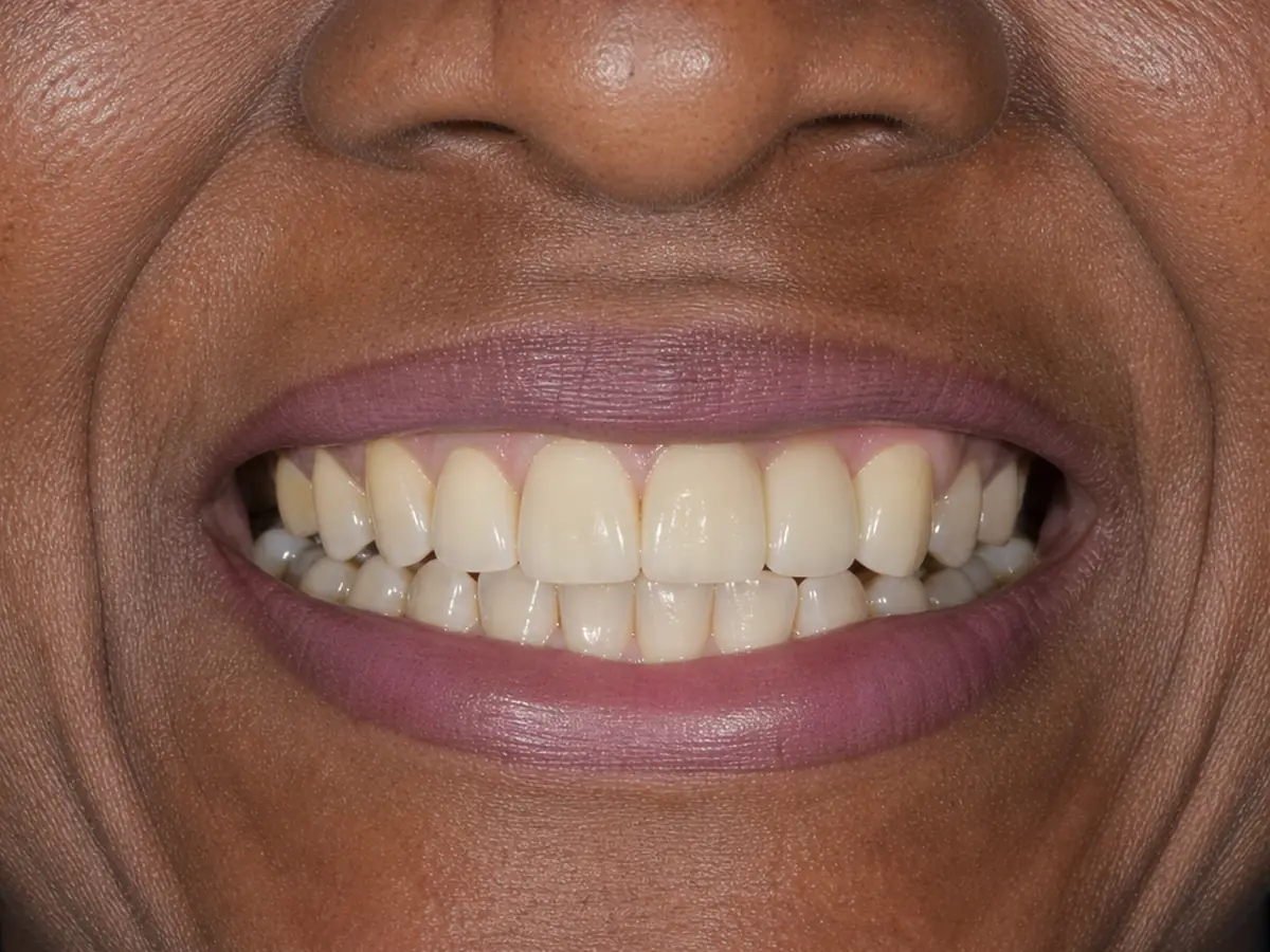 Implant-supported bridge after: missing upper teeth replaced with a fixed bridge