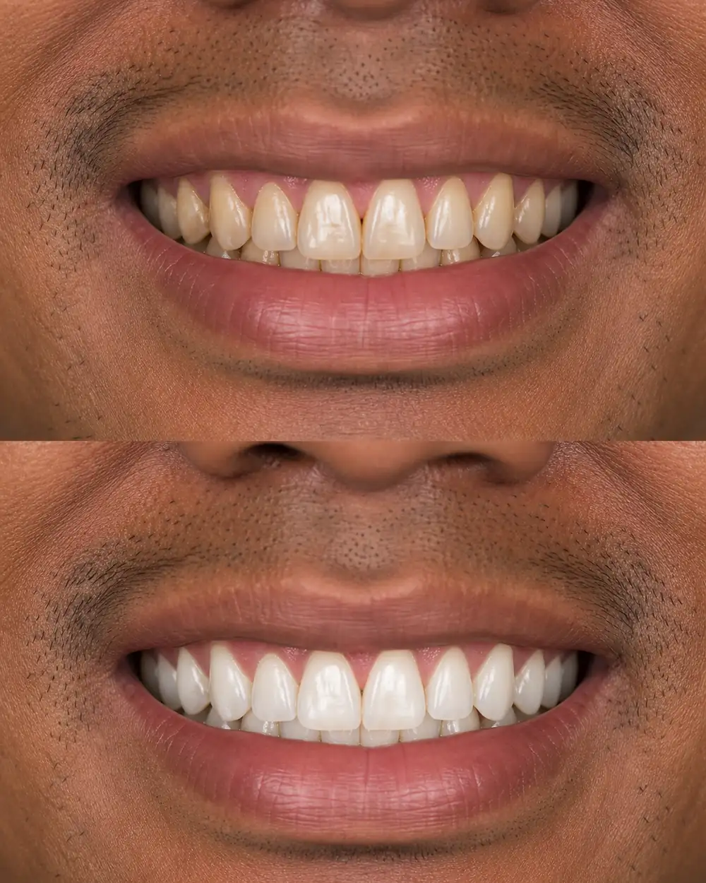 Illustration of stained teeth brightened with professional teeth whitening