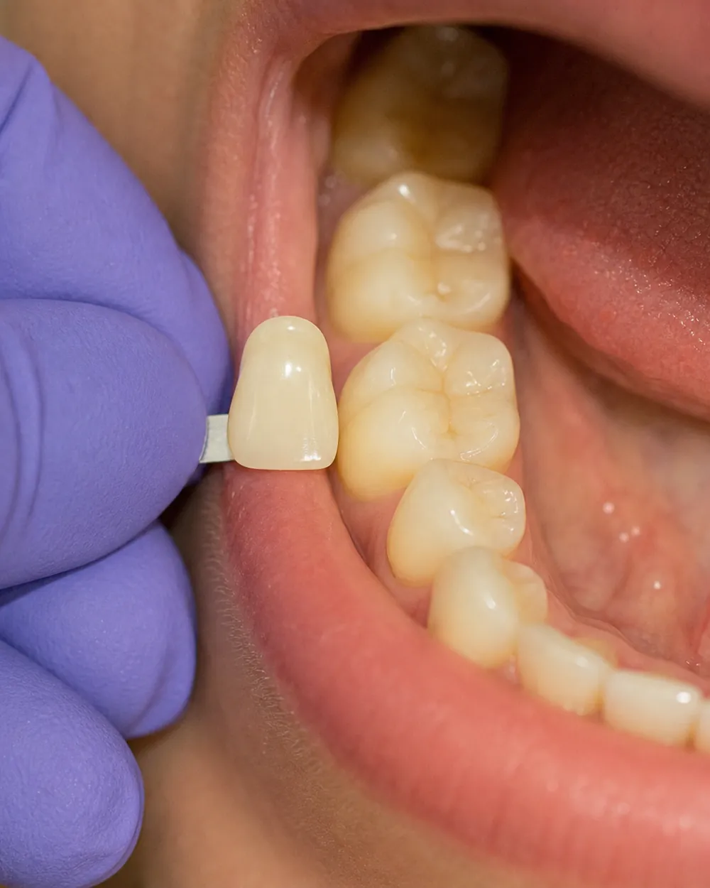 Tooth-colored composite dental filling matched to a natural tooth